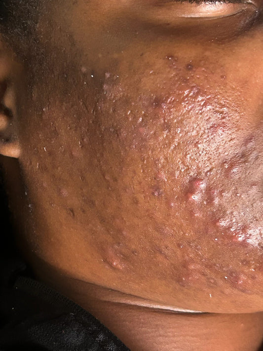 Acneic skin due to hygienic practices; acne located on the lower jaw could signify poor dental hygiene.